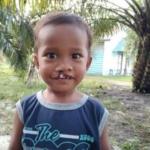 Berkat Operasi Bibir Sumbing Nurman Sinaga Bisa Tersenyum