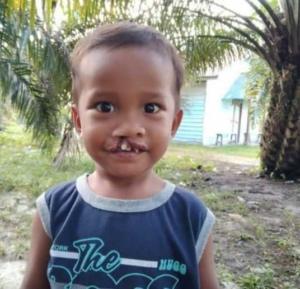 Berkat Operasi Bibir Sumbing Nurman Sinaga Bisa Tersenyum 1 Berkat Operasi Bibir Sumbing Nurman Sinaga Bisa Tersenyum