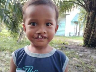 Berkat Operasi Bibir Sumbing Nurman Sinaga Bisa Tersenyum